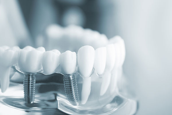 Zahnarztpraxis Dr. Molz - Modell mit Implantaten